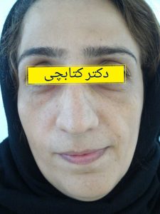 جوانسازی صورت با تزریق چربی